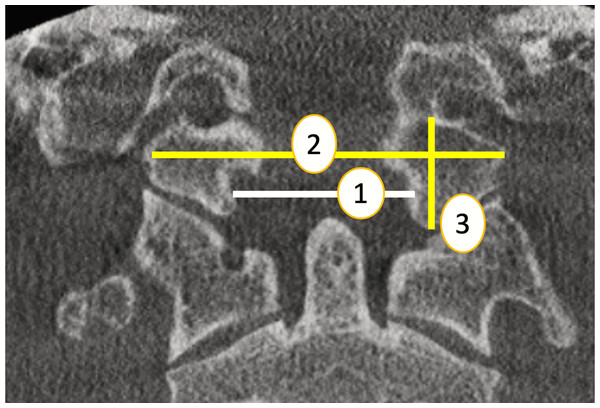 Skull base region parameters (coronal plane)(1:TDFM, 2: WOC , 3: OCH).