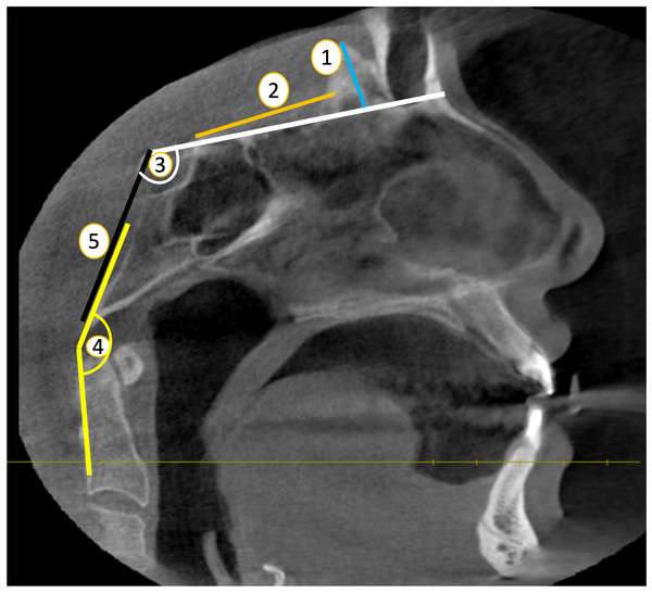 Skull base parameters (Sagittal plane) (1. HCG ; 2.-CG-ATS ; 3. BA; 4. CL; 5. CCA).