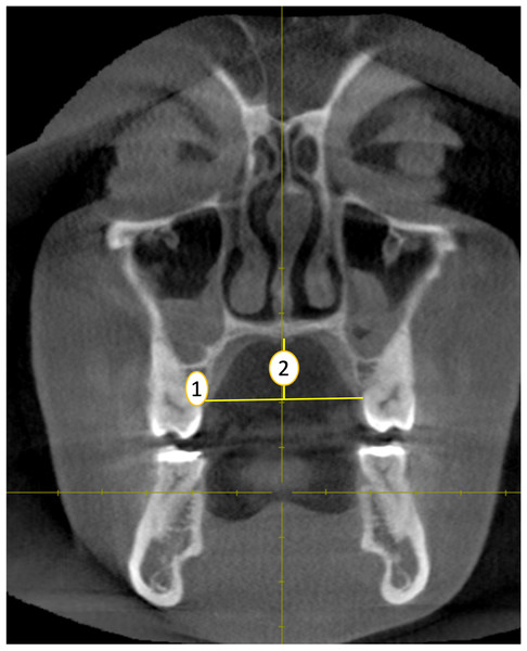 Palatal width (1) and height (2) measurements (coronal plane).