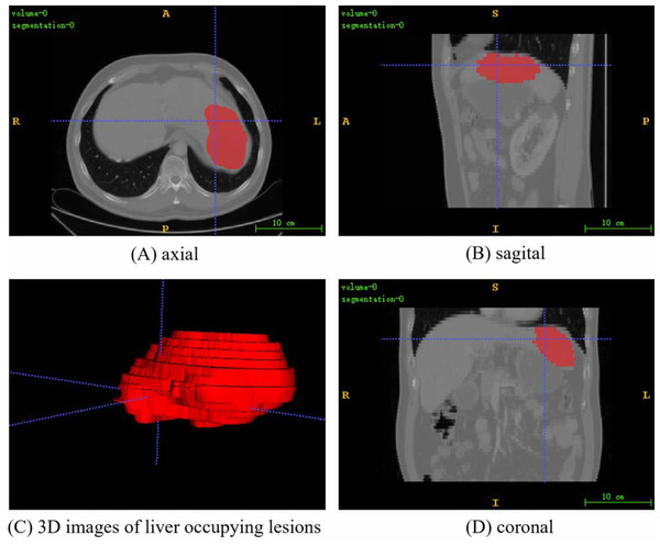 A random fusion CT image from PUFH dataset, resulting from the merging of abdominal CT images and their corresponding annotated images.