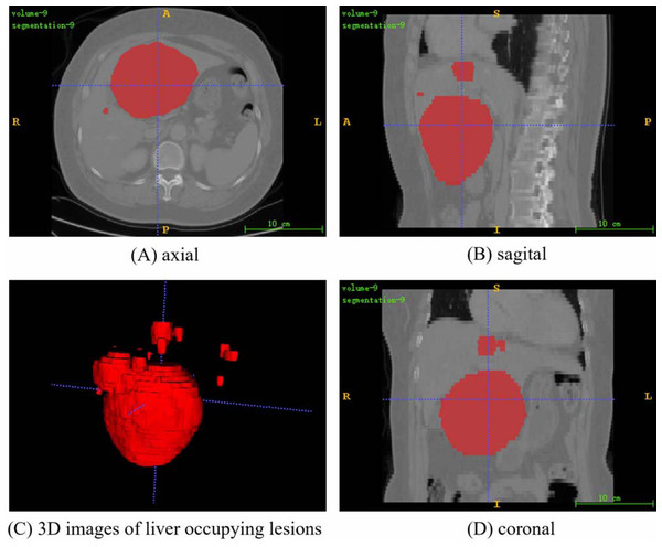 A random fusion CT image from LiTS dataset, resulting from the merging of abdominal CT images and their corresponding annotated images.