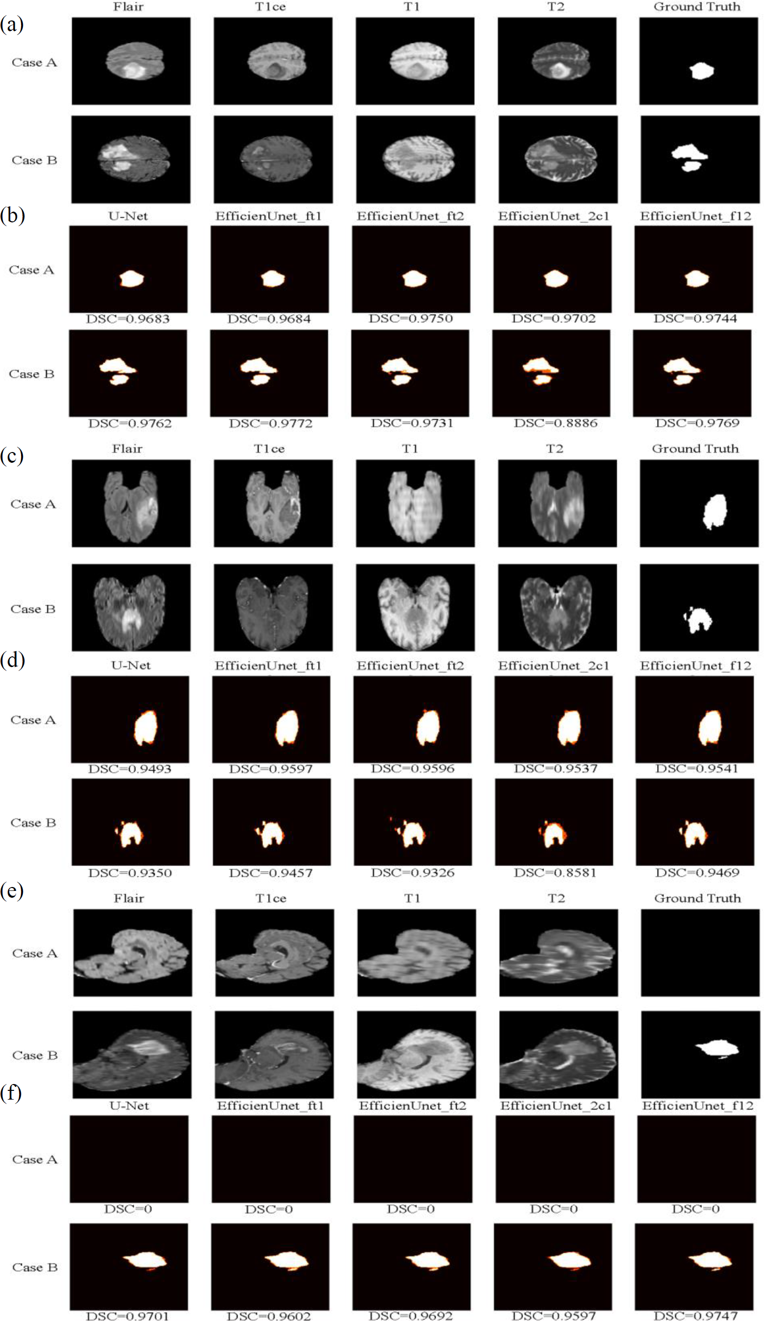 Brain Tumor Segmentation Using U-Net In Conjunction With EfficientNet ...