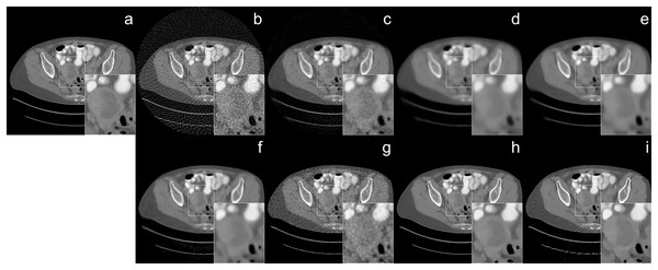 Human CT image reconstruction results from 64-view with 33 dB SNR noise level: (A) ground truth, (B) FBP, (C) SART, (D) SART+TV, (E) SART+BM3D (
$\sigma = 0.35$σ=0.35
), (F) SART+BM3D (
$\sigma = 0.20$σ=0.20
), (G) DIP+TV, (H) FBP+U-Net, (I) Proj2Proj trained on human CT dataset.