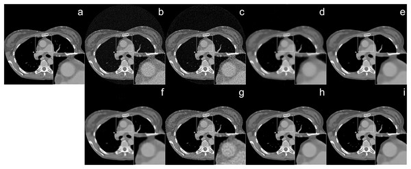 Human CT image reconstruction results from 64-view 37 dB SNR noise level: (A) ground truth, (B) FBP, (C) SART, (D) SART+TV, (E) SART+BM3D (
$\sigma = 0.35$σ=0.35
), (F) SART+BM3D (
$\sigma = 0.20$σ=0.20
), (G) DIP+TV, (H) FBP+U-Net, (I) Proj2Proj trained on human CT dataset.