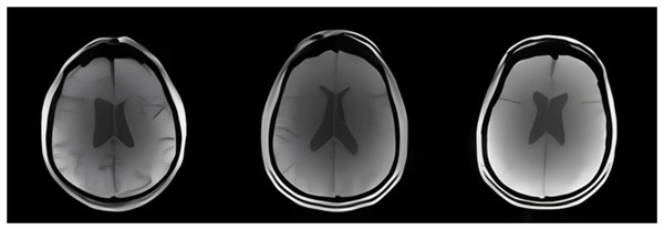 Examples of AD, MCI, and CN MRI images.