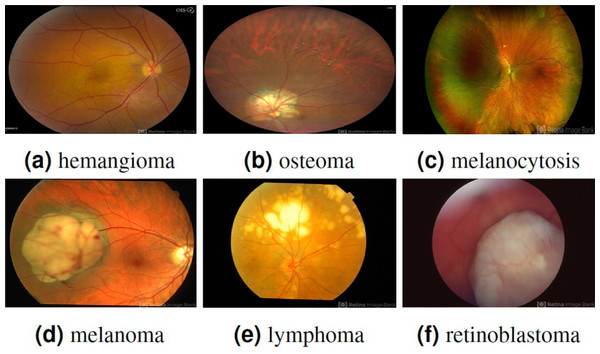 Displaying three benign ocular tumors in the first row and three malignant ocular tumors in the second row.
