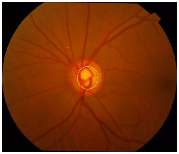 Optic disc and cup disc (the one circled in red is the optic disc, while the one in yellow is the cup disc).