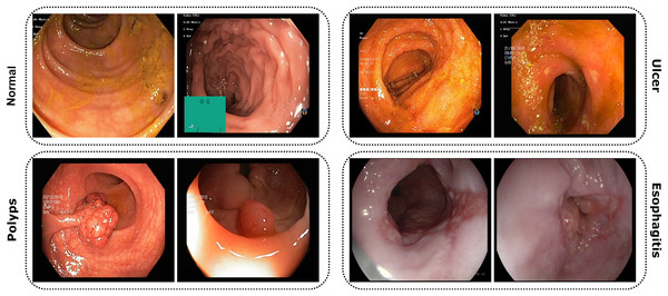 Images from the dataset show four classes: Normal, Ulcer, Polyps, and Esophagitis.