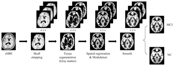 MRI image preprocessing process.