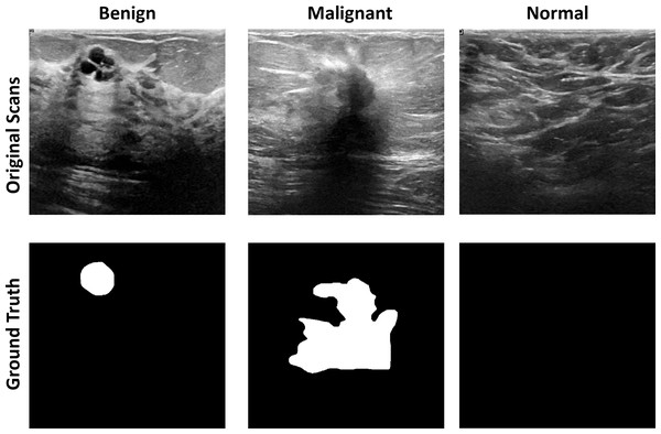 The original images and ground truth masked from the BUS ultrasound imaging dataset.