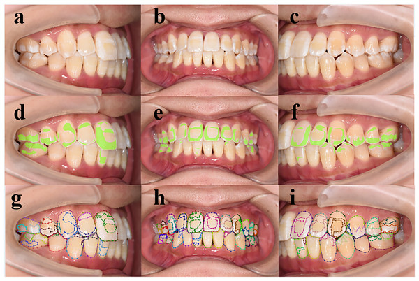 (A–I) Performance of deep learning models in detecting enamel demineralization.