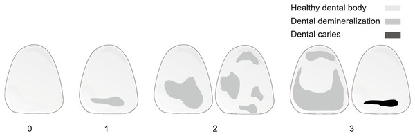 Schematic of optimized demineralization classification.